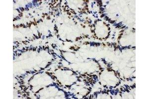 Anti-HDAC3 antibody,  IHC(P) IHC(P): Human Intestinal Cancer Tissue (HDAC3 抗体  (C-Term))