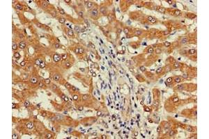 Immunohistochemistry of paraffin-embedded human liver cancer using ABIN7149738 at dilution of 1:100 (DEPDC1B 抗体  (AA 343-529))