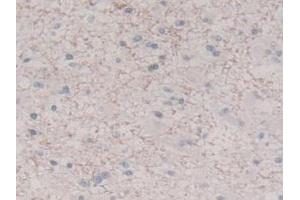 IHC-P analysis of Human Glioma Tissue, with DAB staining. (IL-8 抗体  (AA 23-101))