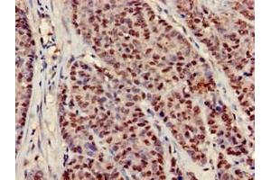 Immunohistochemistry of paraffin-embedded human ovarian cancer using ABIN7151782 at dilution of 1:100