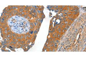 Immunohistochemistry of paraffin-embedded Human cervical cancer using ACOT11 Polyclonal Antibody at dilution of 1:40 (ACOT11 抗体)