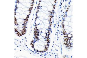 Immunohistochemistry of paraffin-embedded human colon using Chk2 antibody (ABIN7266294) at dilution of 1:100 (40x lens). (CHEK2 抗体)