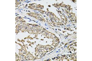 Immunohistochemistry of paraffin-embedded human prostate using RASSF5 antibody. (RASSF5 抗体)