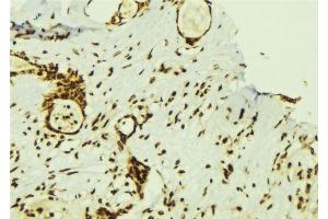 ABIN6274357 at 1/100 staining Human breast cancer tissue by IHC-P. (ZNF638 抗体  (Internal Region))