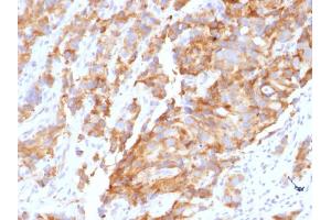 Formalin-fixed, paraffin-embedded human Prostate Carcinoma stained with Aurora B Mouse Monoclonal Antibody (AURKB/1592). (Aurora Kinase B 抗体  (AA 89-251))