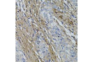 Immunohistochemistry of paraffin-embedded human esophageal cancer using COL1A1 antibody. (COL1A1 抗体)