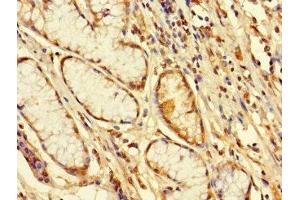 Immunohistochemistry of paraffin-embedded human gastric cancer using ABIN7152491 at dilution of 1:100 (FBXW12 抗体  (AA 1-250))