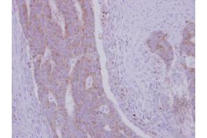 IHC-P Image Immunohistochemical analysis of paraffin-embedded human colon carcinoma, using RRM1, antibody at 1:500 dilution. (RRM1 抗体  (Center))