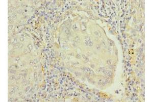Immunohistochemistry of paraffin-embedded human lung cancer using ABIN7167399 at dilution of 1:100 (RAP1B 抗体  (AA 1-181))