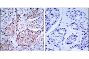 Immunohistochemistry analysis of paraffin-embedded human breast carcinoma, using HER2 (Phospho-Tyr1221/Tyr1222) Antibody. (ErbB2/Her2 抗体  (pTyr1221))