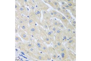 Immunohistochemistry of paraffin-embedded human liver cancer using PON1 antibody at dilution of 1:100 (40x lens). (PON1 抗体)