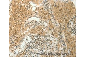 Immunohistochemistry of Human lung cancer using SLC8A3 Polyclonal Antibody at dilution of 1:70 (SLC8A3 抗体)