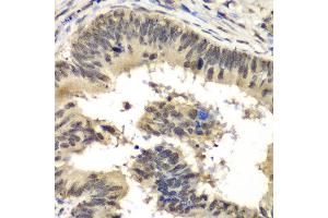 Immunohistochemistry of paraffin-embedded human colon carcinoma using RBBP5 antibody at dilution of 1:100 (x40 lens). (RBBP5 抗体)