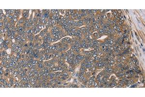 Immunohistochemistry of paraffin-embedded Human cervical cancer using HSD17B12 Polyclonal Antibody at dilution of 1:30 (HSD17B12 抗体)