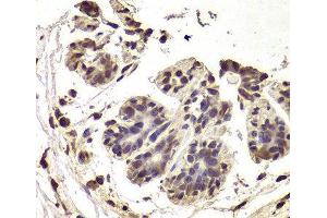 Immunohistochemistry of paraffin-embedded Human breast cancer using INTS6 Polyclonal Antibody at dilution of 1:100 (40x lens). (INTS6 抗体)
