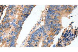 Immunohistochemistry of paraffin-embedded Human colon cancer tissue using MUC6 Polyclonal Antibody at dilution 1:40 (MUC6 抗体)