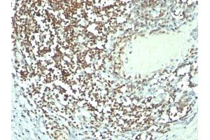 Formalin-fixed, paraffin-embedded human Bladder carcinoma stained with Nucleolin MAb (364-5 + NCL/902). (Nucleolin 抗体)