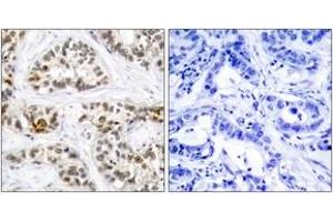 Immunohistochemistry analysis of paraffin-embedded human breast carcinoma, using RelB (Phospho-Ser552) Antibody.