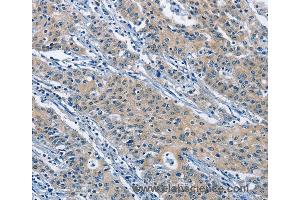 Immunohistochemistry of Human gastric cancer using KLF7 Polyclonal Antibody at dilution of 1:60 (KLF7 抗体)