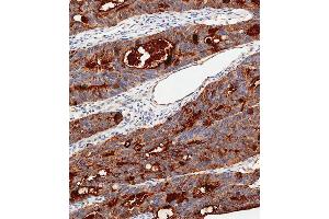 Immunohistochemical analysis of paraffin-embedded Human colon carcinoma tissue using C performed on the Leica® BOND RXm. (CEA 抗体  (AA 400-429))