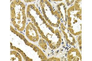 Immunohistochemistry of paraffin-embedded Human kidney cancer using UGT1A4 Polyclonal Antibody at dilution of 1:200 (40x lens). (UGT1A4 抗体)