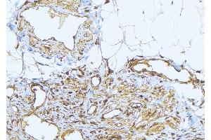 ABIN6275232 at 1/100 staining Human lung cancer tissue by IHC-P. (MRPS2 抗体  (C-Term))