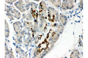 Anti- PAX6 Picoband antibody, IHC(P) IHC(P): Human Pancreatic Cancer Tissue (PAX6 抗体  (Middle Region))