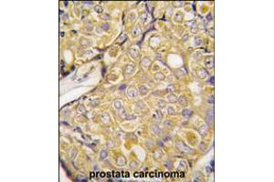 Formalin-fixed and paraffin-embedded human prostata carcinoma tissue reacted with , which was peroxidase-conjugated to the secondary antibody, followed by DAB staining. (TRPM8 抗体  (AA 521-552))