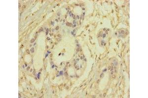 Immunohistochemistry of paraffin-embedded human pancreatic cancer using ABIN7170681 at dilution of 1:100 (SRPK3 抗体  (AA 1-300))
