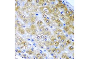 Immunohistochemistry of paraffin-embedded human liver cancer using BMF antibody at dilution of 1:200 (40x lens). (BMF 抗体)