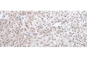 Immunohistochemistry of paraffin-embedded Human ovarian cancer tissue using HOXC11 Polyclonal Antibody at dilution of 1:25(x200) (HOXC11 抗体)