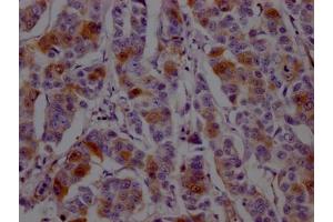IHC image of ABIN7127454 diluted at 1:100 and staining in paraffin-embedded human breast cancer performed on a Leica BondTM system. (Recombinant Dihydrofolate Reductase 抗体)