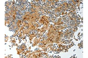 The image on the left is immunohistochemistry of paraffin-embedded Human tonsil tissue using ABIN7130695(PRCP Antibody) at dilution 1/20, on the right is treated with fusion protein. (PRCP 抗体)
