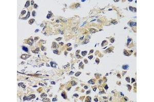 Immunohistochemistry of paraffin-embedded Human lung cancer using C12orf10 Polyclonal Antibody at dilution of 1:100 (40x lens). (C12orf10 抗体)