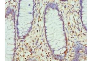 Immunohistochemistry of paraffin-embedded human colon cancer using ABIN7158341 at dilution of 1:100 (LIMS1 抗体  (AA 1-325))