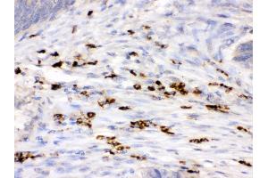 Anti- Lysozyme Picoband antibody, IHC(P) IHC(P): Human Intestinal Cancer Tissue (LYZ 抗体  (C-Term))