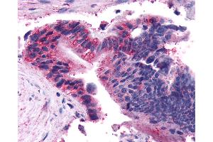Anti-FZD5 / Frizzled 5 antibody IHC of human Colon, Carcinoma. (FZD5 抗体  (N-Term))