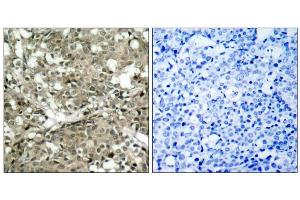 Immunohistochemical analysis of paraffin-embedded human breast carcinoma tissue using c-Abl (Ab-412) antibody (E021156). (ABL1 抗体)