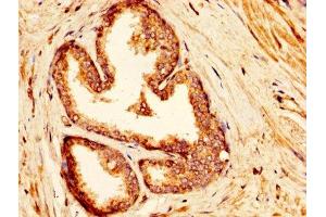 IHC image of ABIN7143895 diluted at 1:300 and staining in paraffin-embedded human prostate cancer performed on a Leica BondTM system. (IDUA 抗体  (AA 28-653))