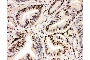 IHC-P: IRF1 antibody testing of human intestinal cancer tissue