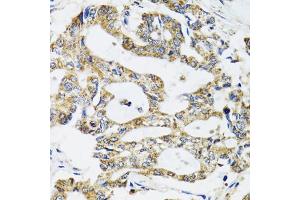 Immunohistochemistry of paraffin-embedded human colon carcinoma using SSBP1 antibody (ABIN2560148) at dilution of 1:100 (40x lens). (SSBP1 抗体)