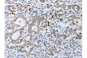 The image on the left is immunohistochemistry of paraffin-embedded Human gastic cancer tissue using ABIN7189583(ABCB9 Antibody) at dilution 1/15, on the right is treated with synthetic peptide. (ABCB9 抗体)