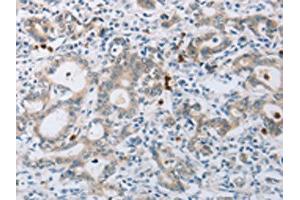 The image on the left is immunohistochemistry of paraffin-embedded Human gastic cancer tissue using ABIN7189583(ABCB9 Antibody) at dilution 1/15, on the right is treated with synthetic peptide.