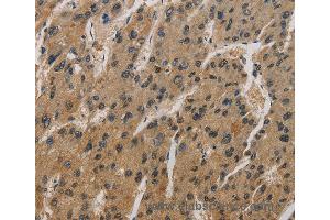 Immunohistochemistry of Human liver cancer using CORO1C Polyclonal Antibody at dilution of 1:50