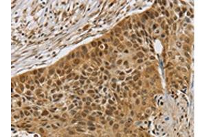 The image on the left is immunohistochemistry of paraffin-embedded Human esophagus cancer tissue using ABIN7192565(SMC6 Antibody) at dilution 1/30, on the right is treated with synthetic peptide. (SMC6 抗体)