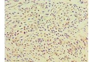 Immunohistochemistry of paraffin-embedded human breast cancer using ABIN7166414 at dilution of 1:100 (Transglutaminase 2 抗体  (AA 438-687))