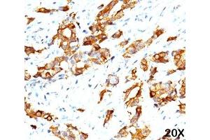 IHC testing of breast carcinoma (20X) stained with HSP27 antibody (G3. (HSP27 抗体)