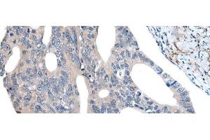 Immunohistochemistry of paraffin-embedded Human colorectal cancer tissue using UBR4 Polyclonal Antibody at dilution of 1:55(x200) (UBR4 抗体)