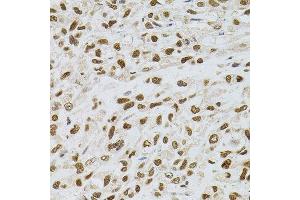Immunohistochemistry of paraffin-embedded human lung cancer using TGM2 antibody. (Transglutaminase 2 抗体)