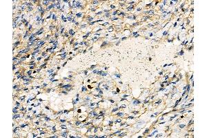 ABIN6262655 and ABIN6276467 at 1/100 staining Human ovarian cancer and adjacent normal tissues by IHC-P. (IRF4 抗体  (C-Term))